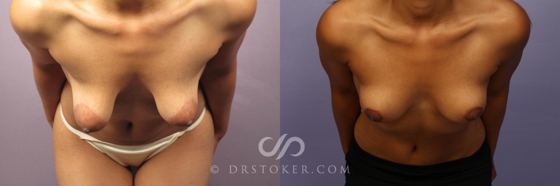 Before & After Breast Lift Case 426 View #2 View in Los Angeles, CA