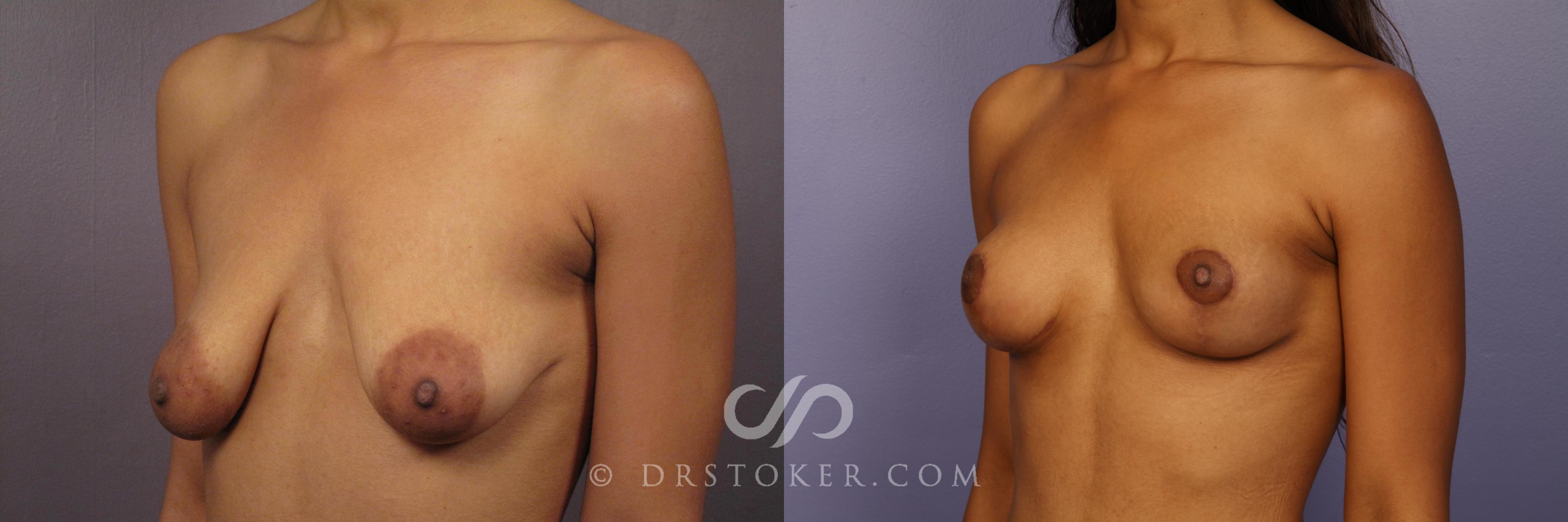 Before & After Breast Lift Case 426 View #4 View in Los Angeles, CA