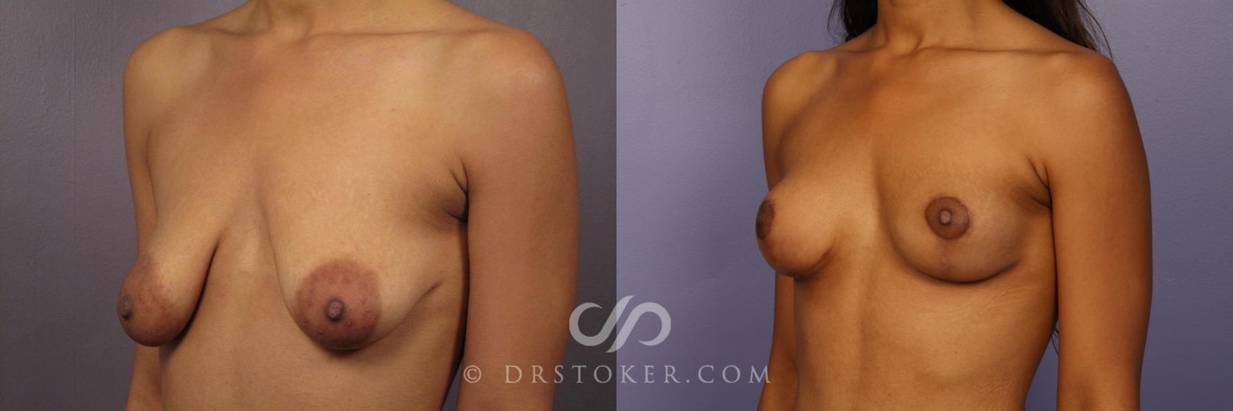 Before & After Breast Lift Case 426 View #4 View in Los Angeles, CA