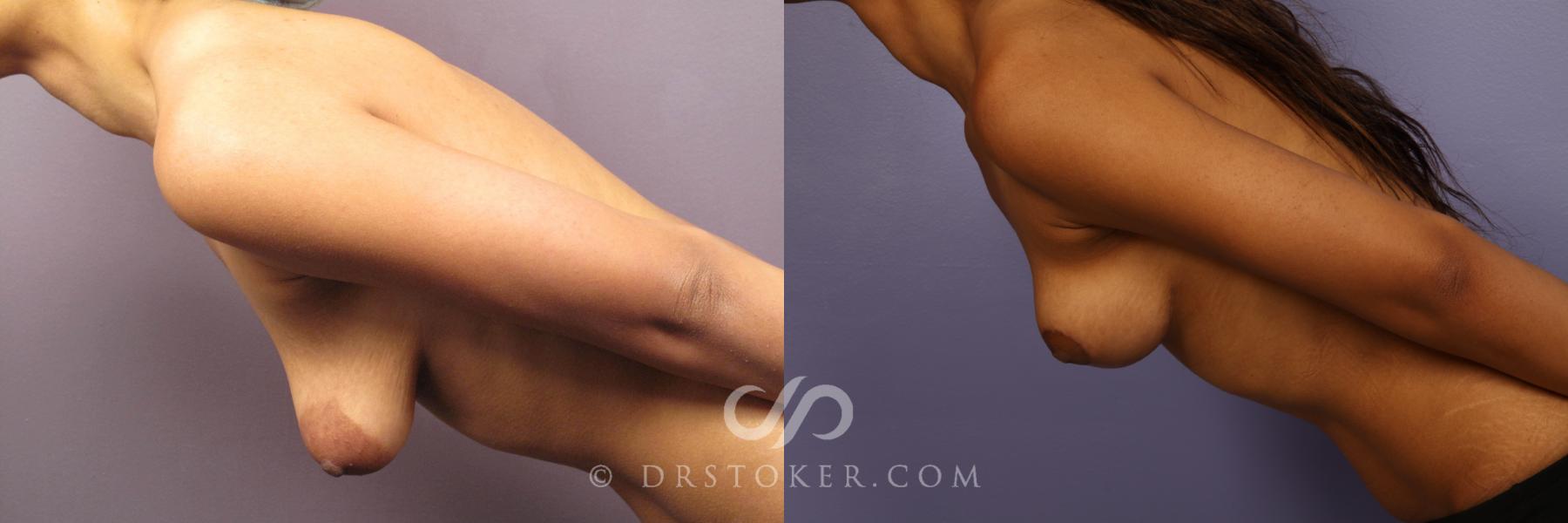 Before & After Breast Lift Case 426 View #8 View in Los Angeles, CA