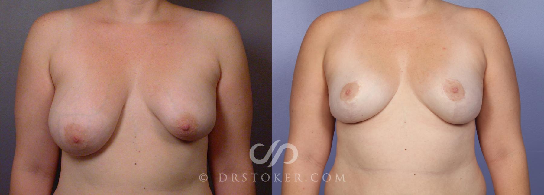 Before & After Breast Lift Case 488 View #1 View in Los Angeles, CA
