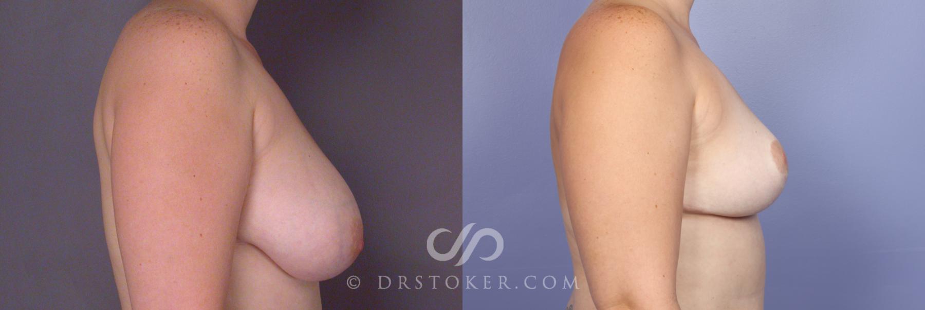 Before & After Breast Lift Case 488 View #2 View in Los Angeles, CA