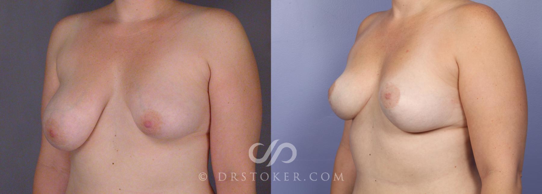 Before & After Breast Asymmetry Correction Case 488 View #3 View in Los Angeles, CA