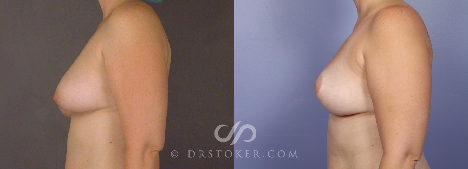 Before & After Breast Asymmetry Correction Case 488 View #4 View in Los Angeles, CA
