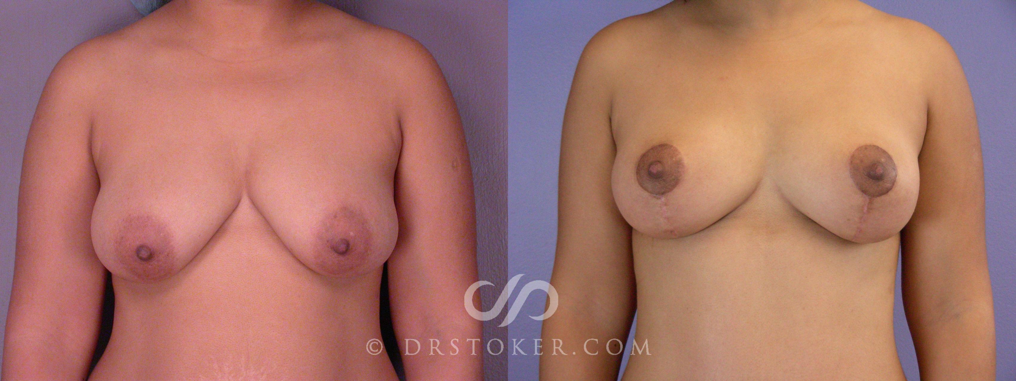 Before & After Breast Lift Case 514 View #1 View in Los Angeles, CA