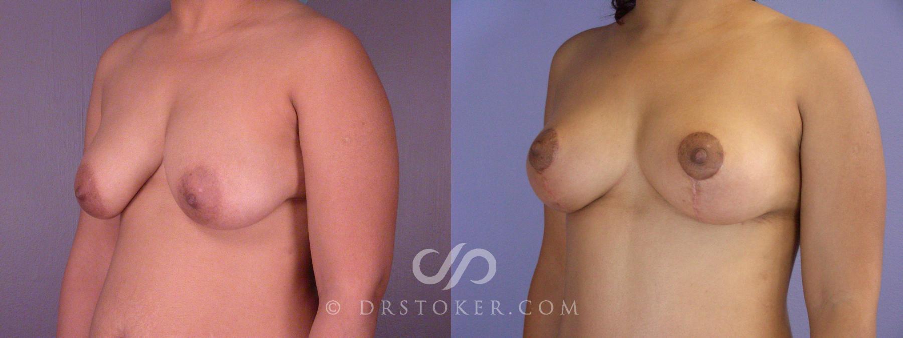 Before & After Breast Lift Case 514 View #3 View in Los Angeles, CA