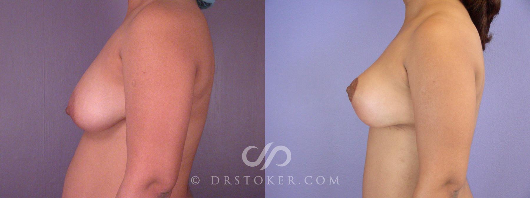 Before & After Breast Lift Case 514 View #5 View in Los Angeles, CA
