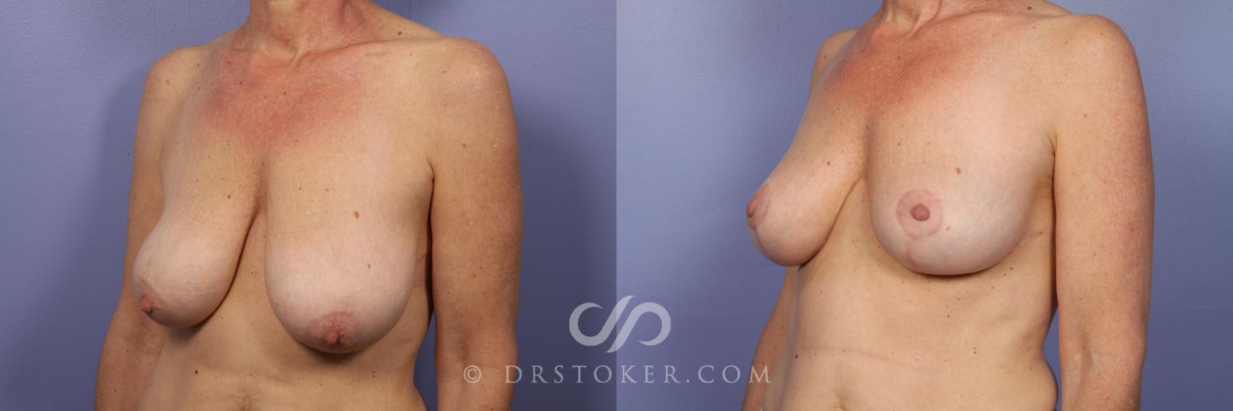 Before & After Breast Lift Case 516 View #2 View in Los Angeles, CA