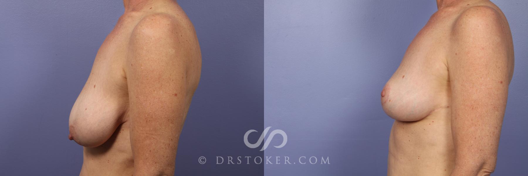 Before & After Breast Lift Case 516 View #4 View in Los Angeles, CA