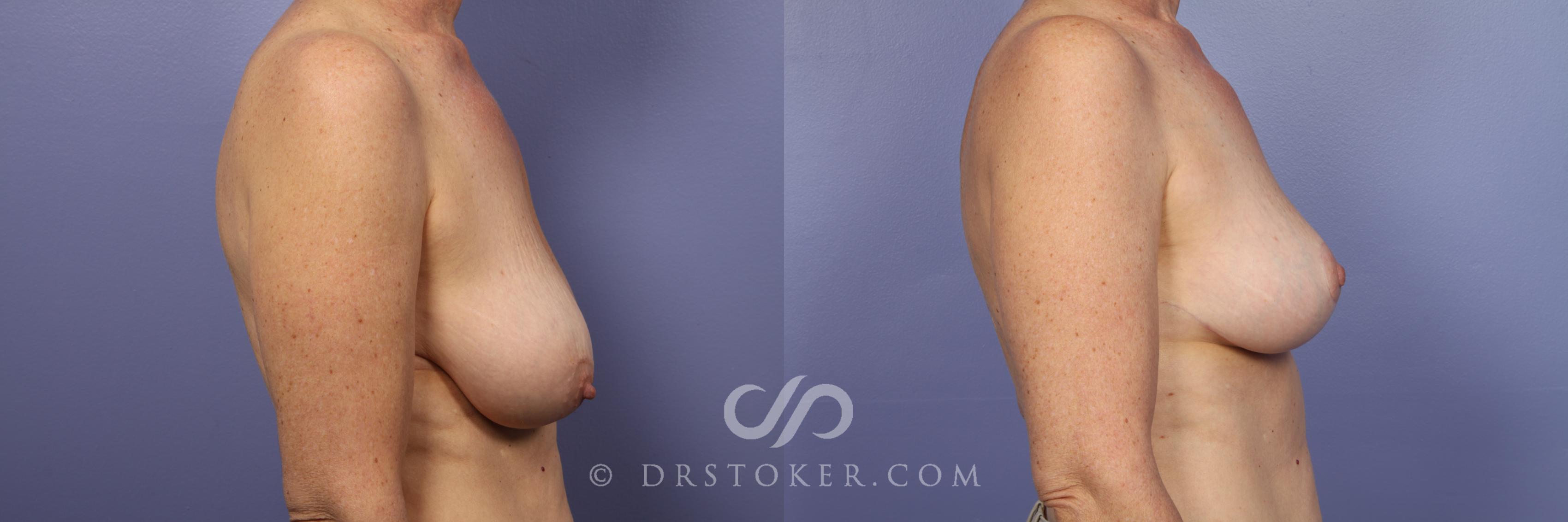 Before & After Breast Lift Case 516 View #5 View in Los Angeles, CA