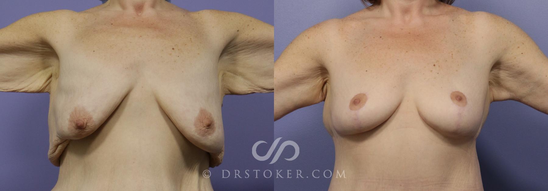 Before & After Breast Lift Case 933 View #1 View in Los Angeles, CA