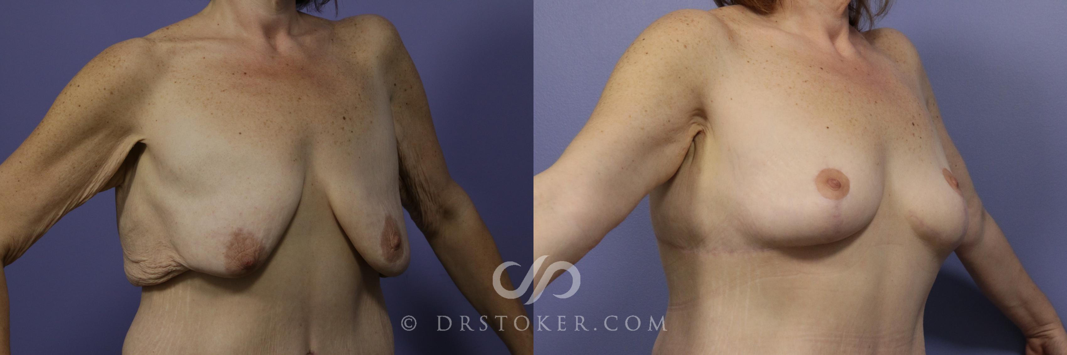 Before & After Breast Lift Case 933 View #2 View in Los Angeles, CA