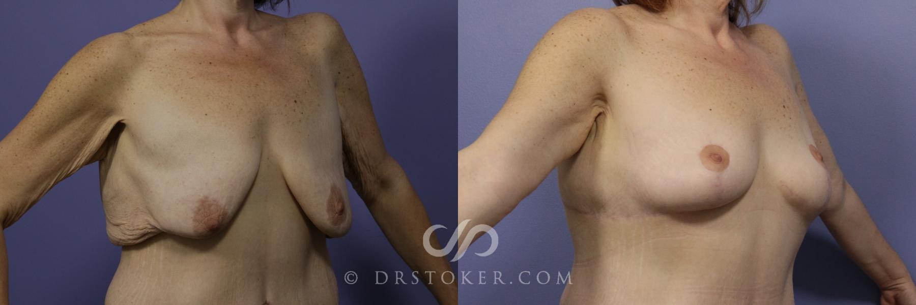 Before & After Breast Lift Case 933 View #2 View in Los Angeles, CA