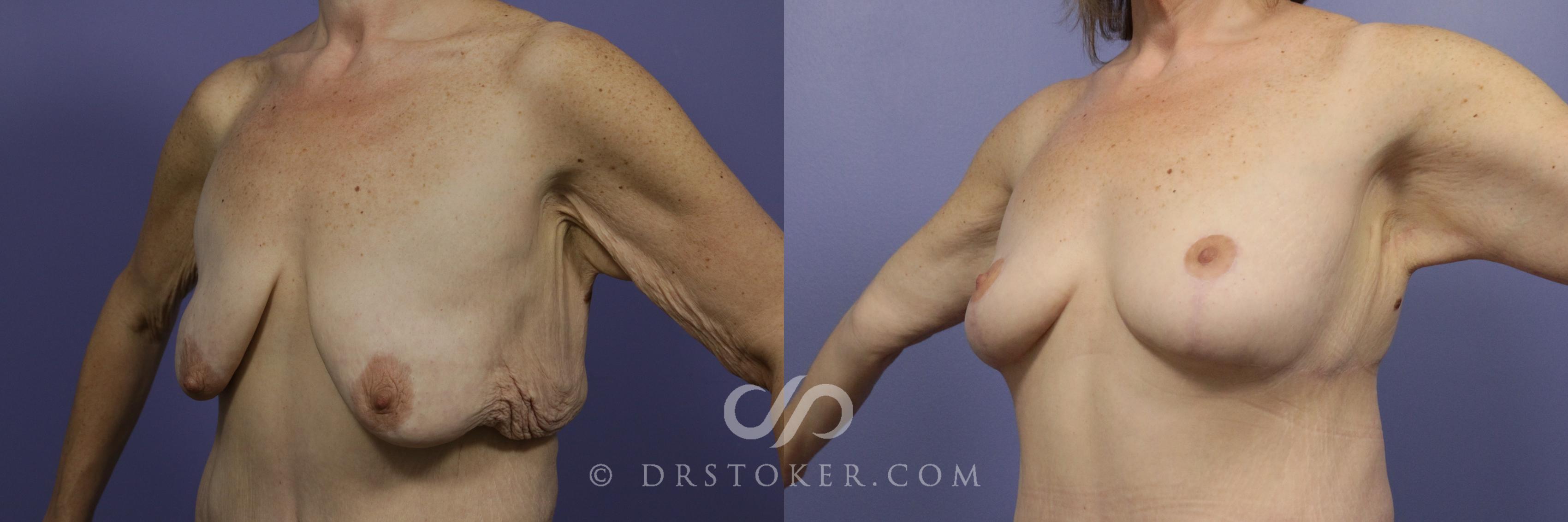 Before & After Breast Lift Case 934 View #1 View in Los Angeles, CA
