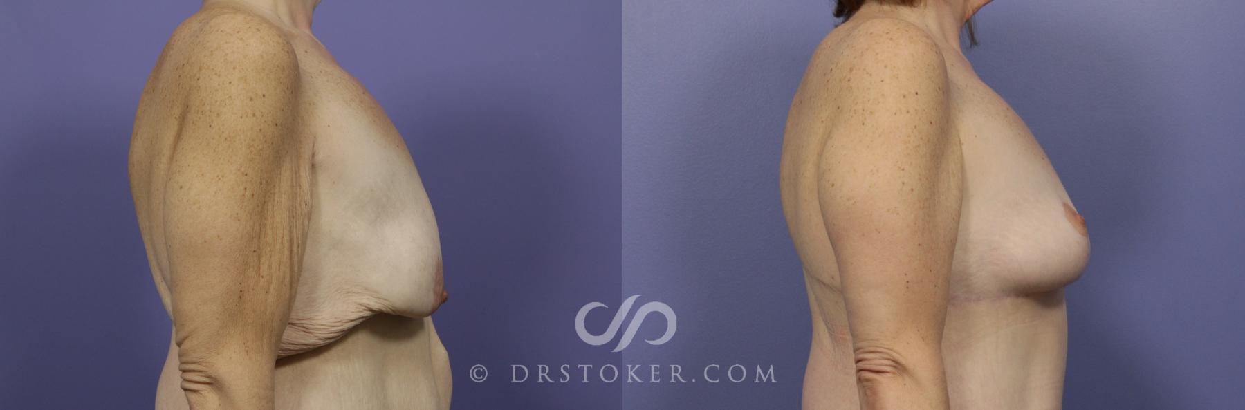 Before & After Breast Lift Case 934 View #2 View in Los Angeles, CA