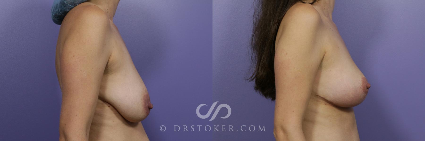 Before & After Breast Lift Case 936 View #4 View in Los Angeles, CA