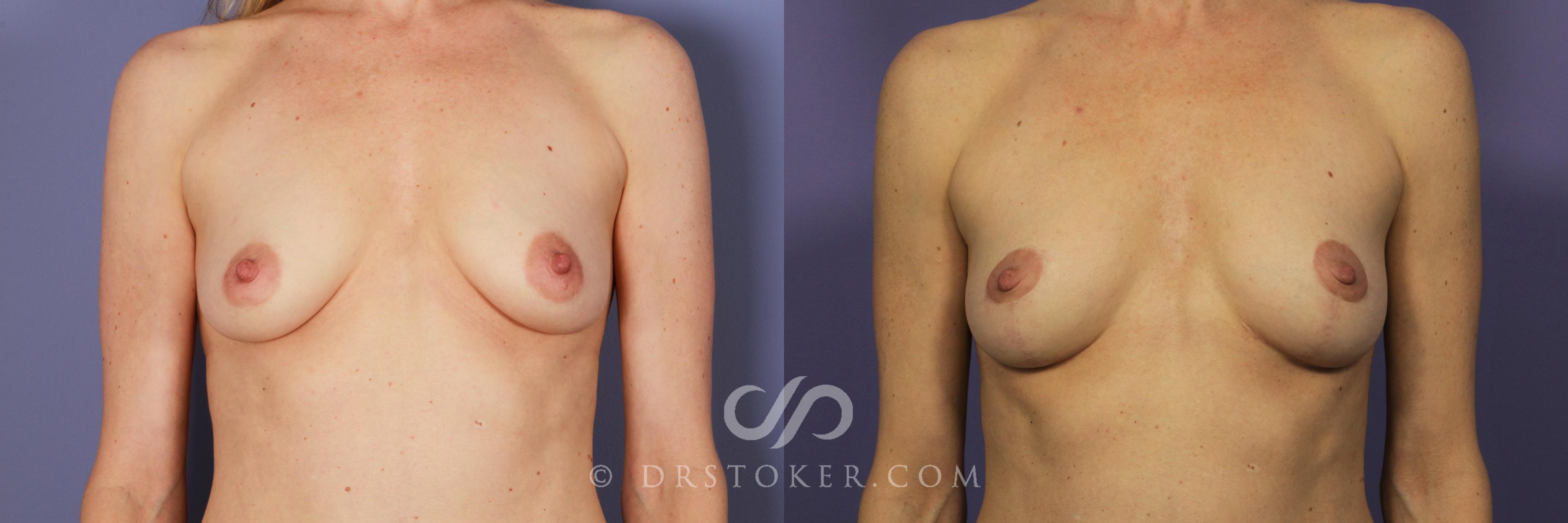 Before & After Breast Lift Case 937 View #1 View in Los Angeles, CA