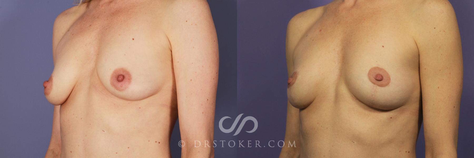 Before & After Breast Lift Case 937 View #2 View in Los Angeles, CA