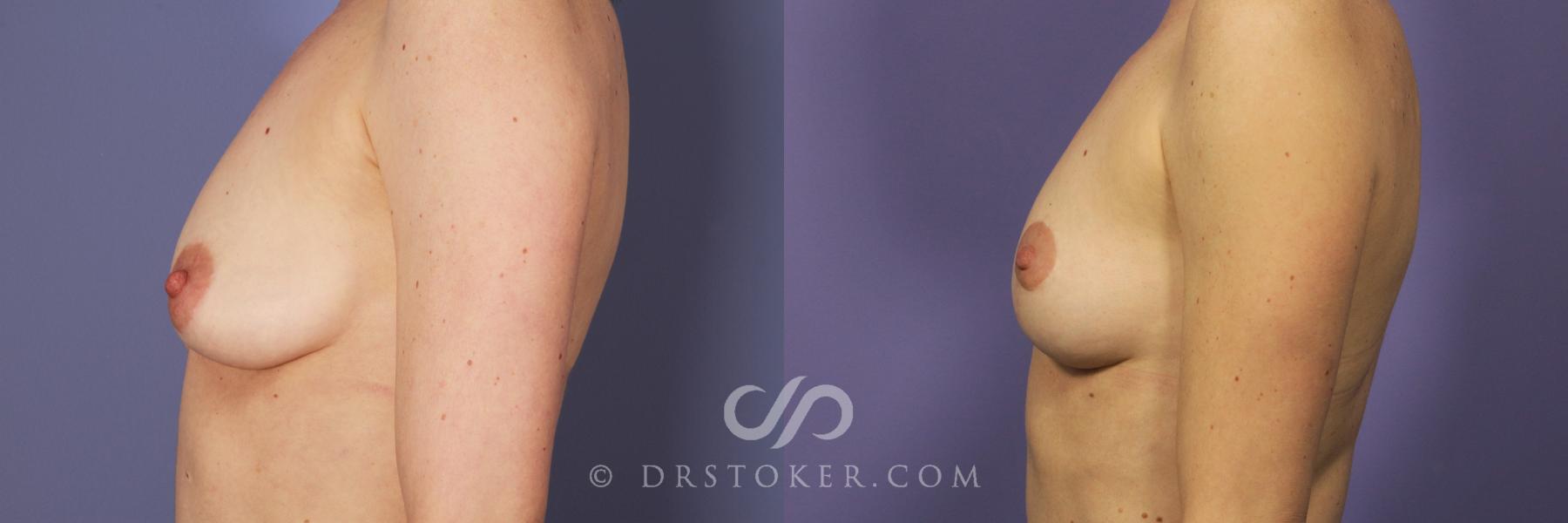 Before & After Breast Lift Case 937 View #3 View in Los Angeles, CA