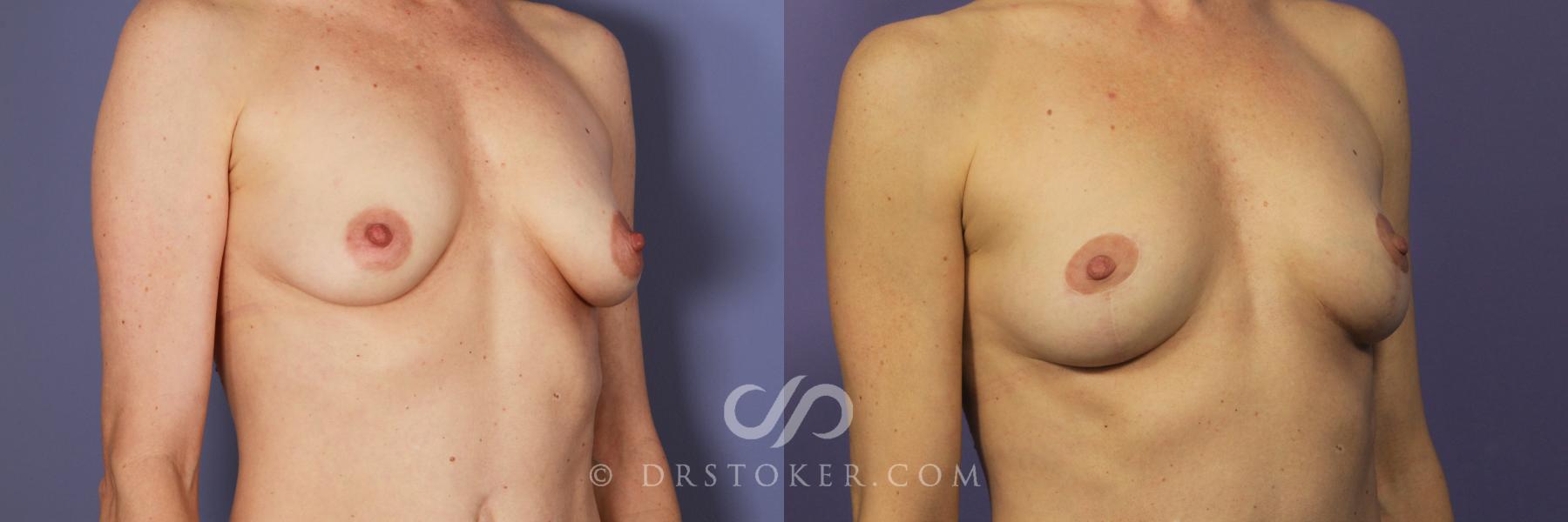 Before & After Breast Lift Case 937 View #4 View in Los Angeles, CA