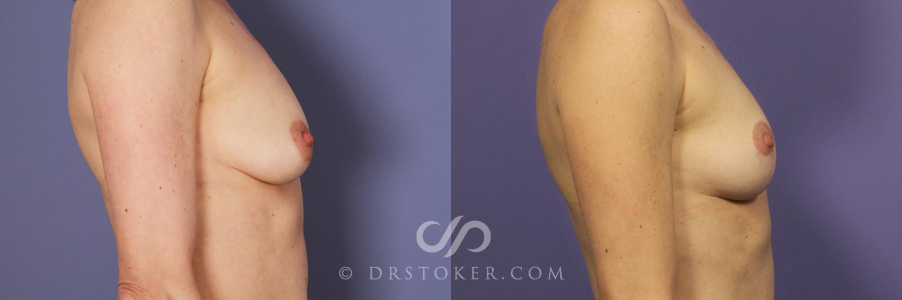 Before & After Breast Lift Case 937 View #5 View in Los Angeles, CA