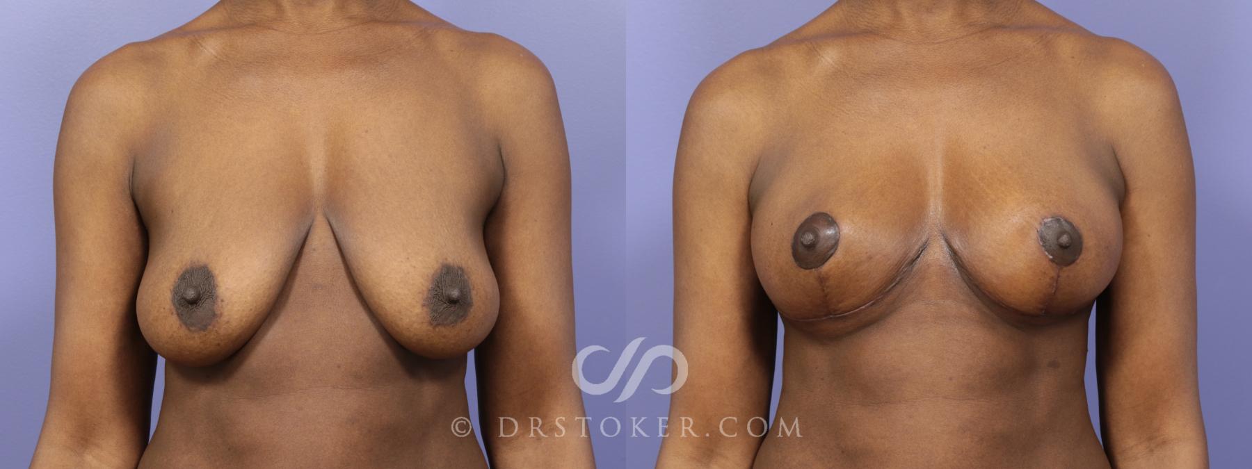 Before & After Breast Lift Case 938 View #1 View in Los Angeles, CA