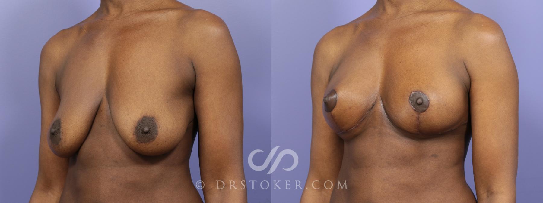Before & After Breast Lift Case 938 View #2 View in Los Angeles, CA