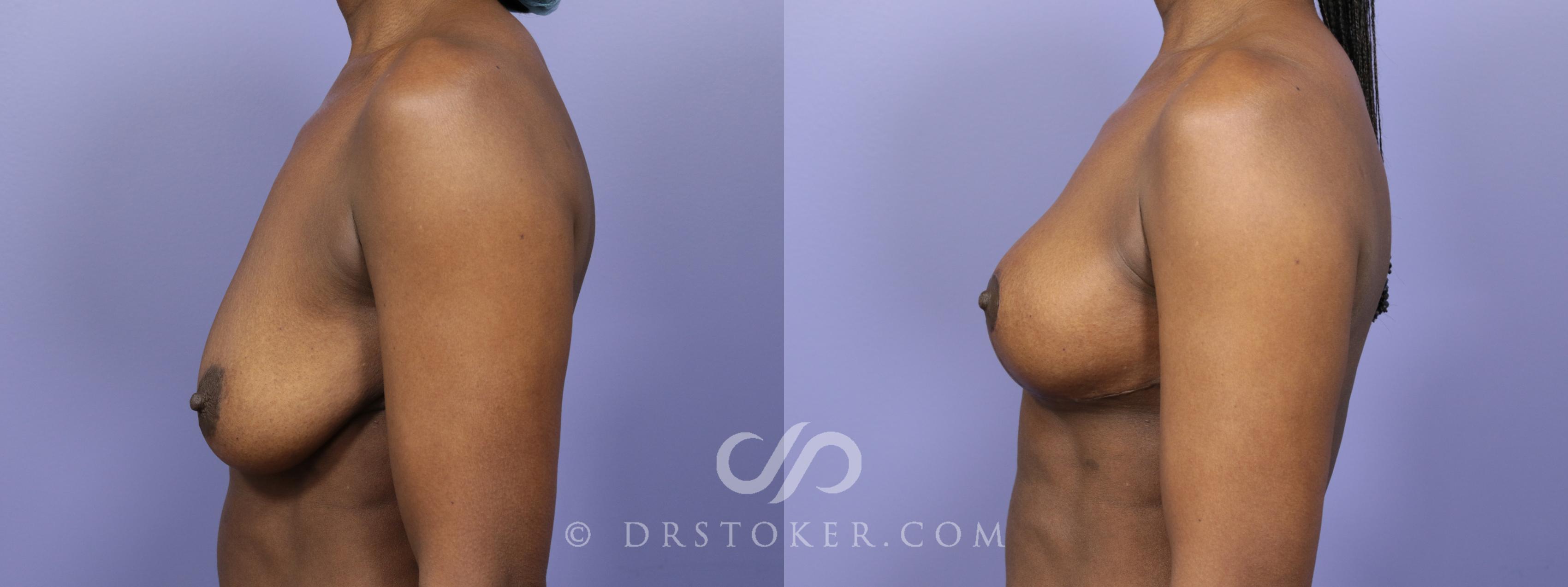 Before & After Breast Lift Case 938 View #3 View in Los Angeles, CA