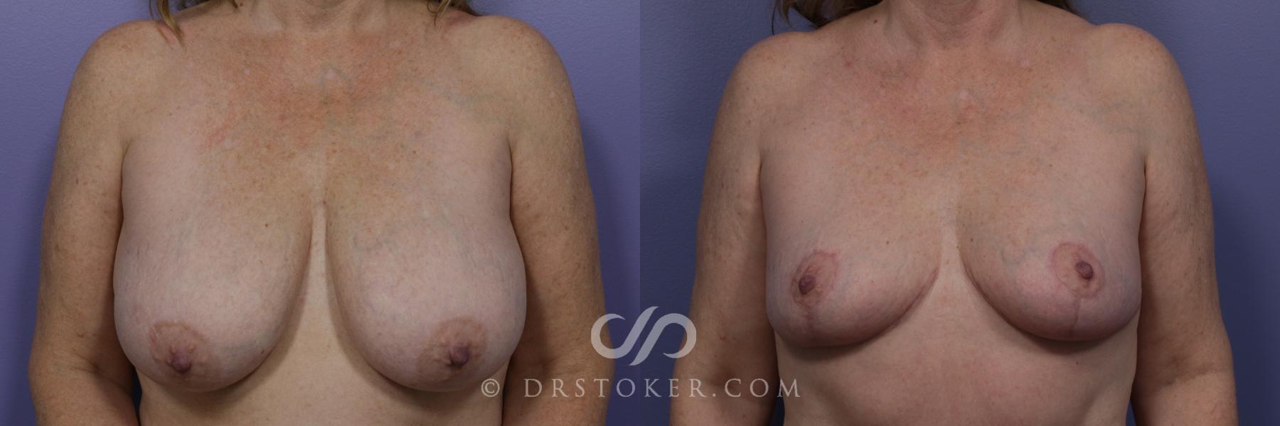 Before & After Breast Lift Case 939 View #1 View in Los Angeles, CA