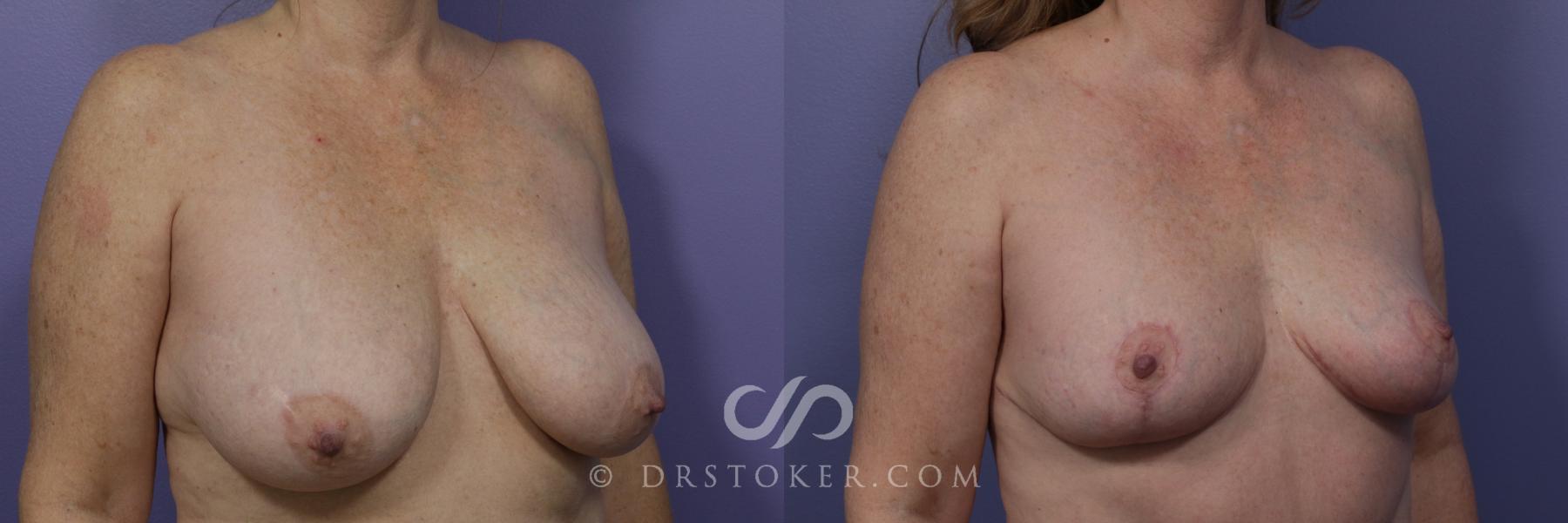 Before & After Breast Lift Case 939 View #2 View in Los Angeles, CA
