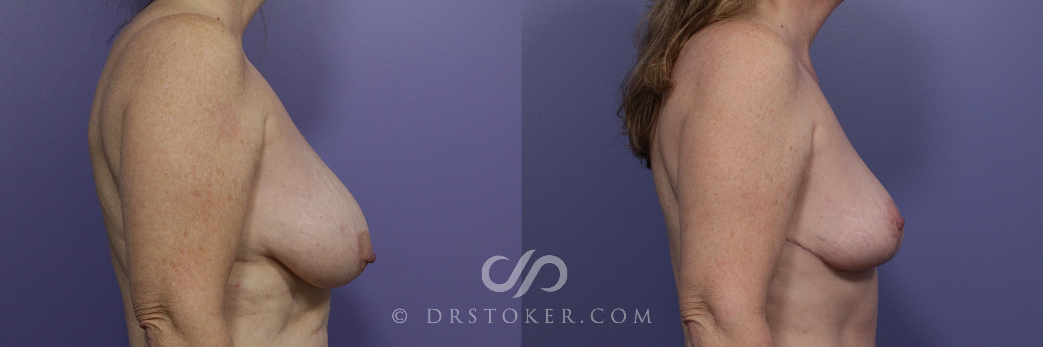 Before & After Breast Lift Case 939 View #3 View in Los Angeles, CA