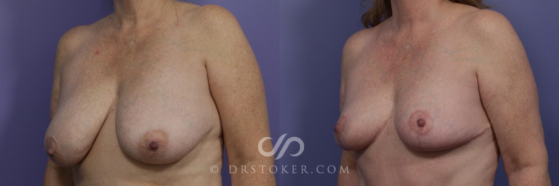 Before & After Breast Lift Case 939 View #4 View in Los Angeles, CA