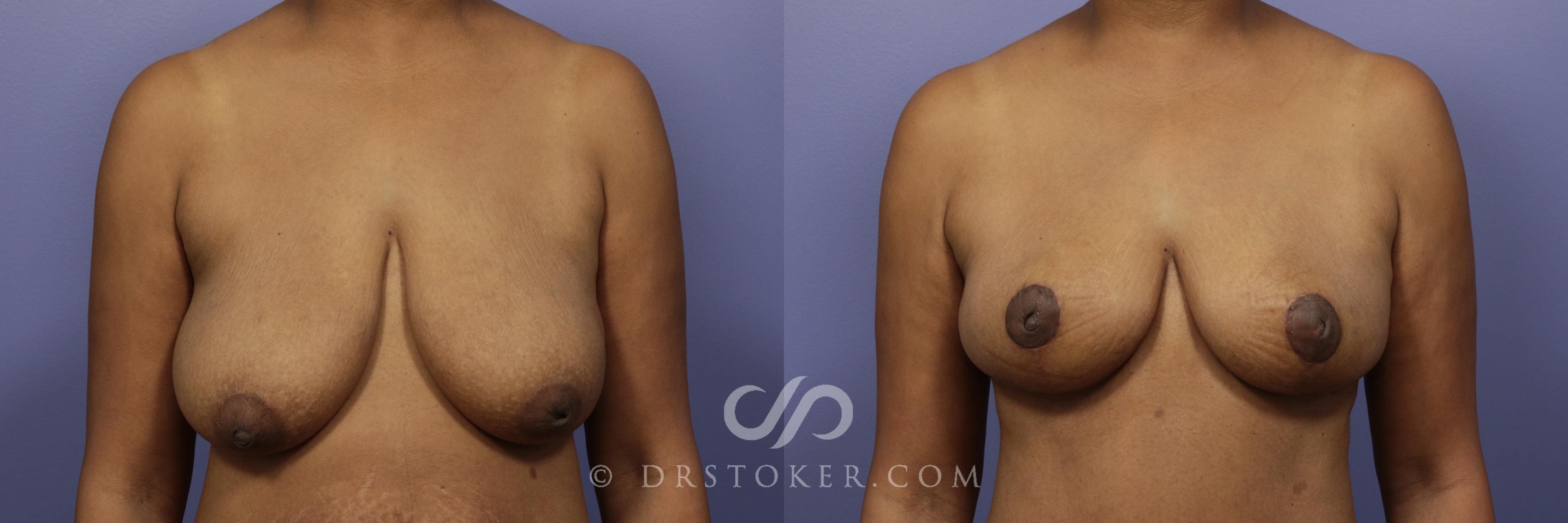 Before & After Breast Lift Case 941 View #1 View in Los Angeles, CA