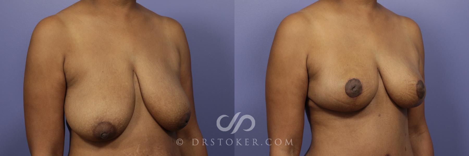 Before & After Breast Lift Case 941 View #2 View in Los Angeles, CA