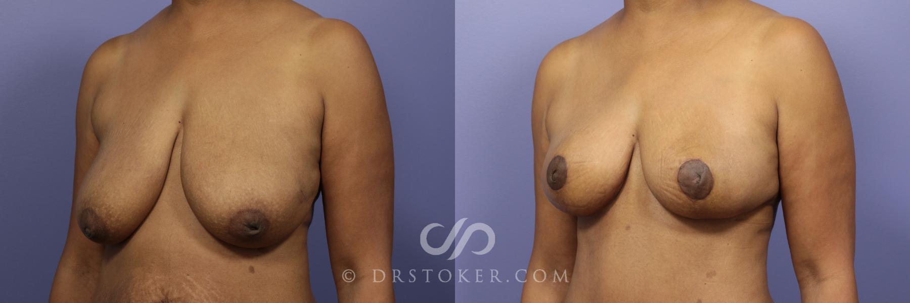 Before & After Breast Lift Case 941 View #3 View in Los Angeles, CA