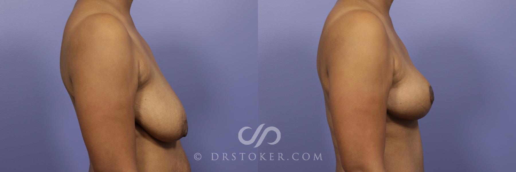 Before & After Breast Lift Case 941 View #4 View in Los Angeles, CA