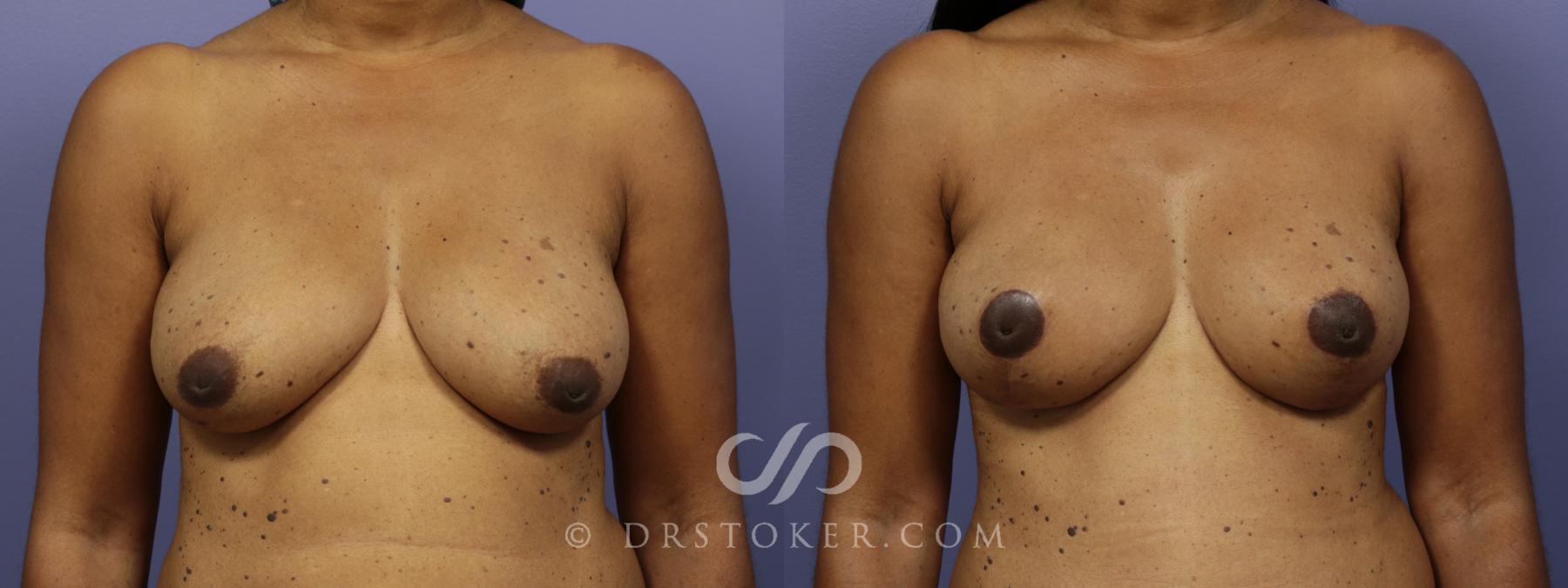 Before & After Breast Lift Case 942 View #1 View in Los Angeles, CA