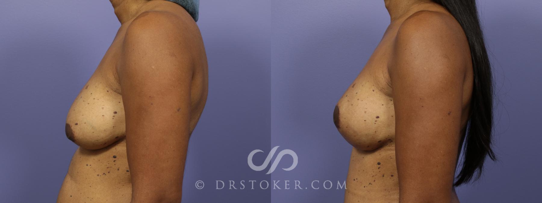 Before & After Breast Lift Case 942 View #2 View in Los Angeles, CA