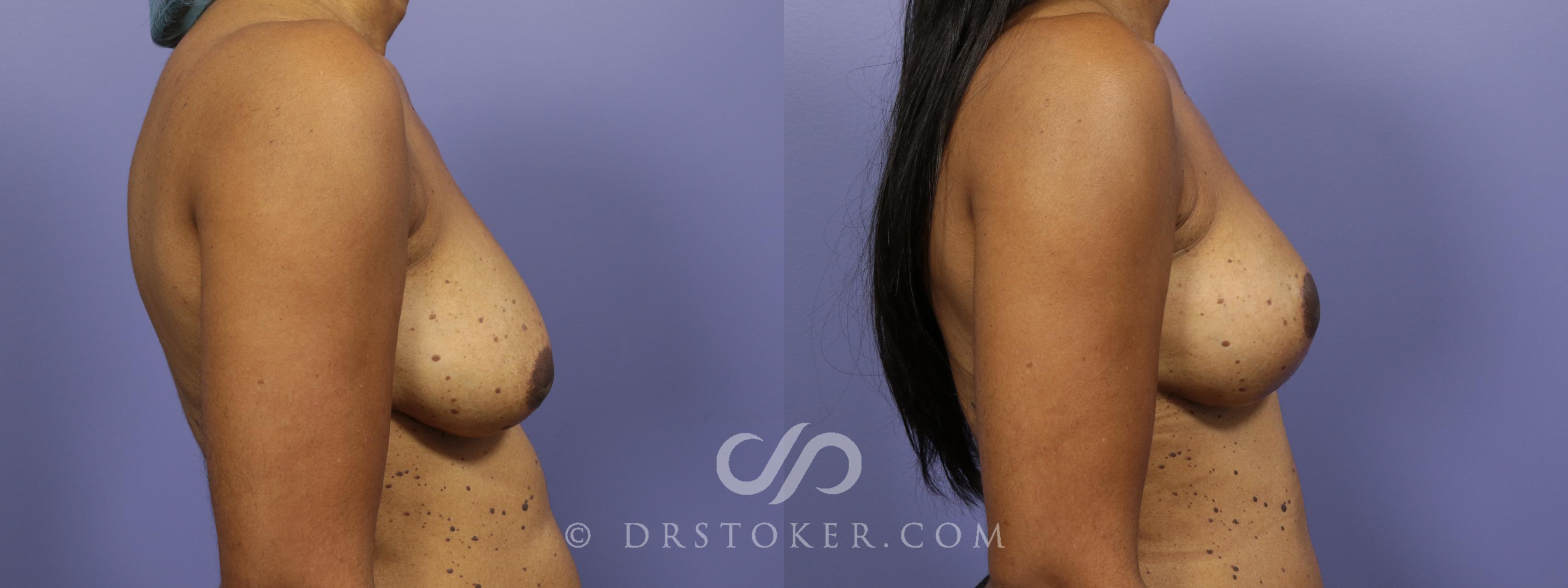 Before & After Breast Lift Case 942 View #3 View in Los Angeles, CA