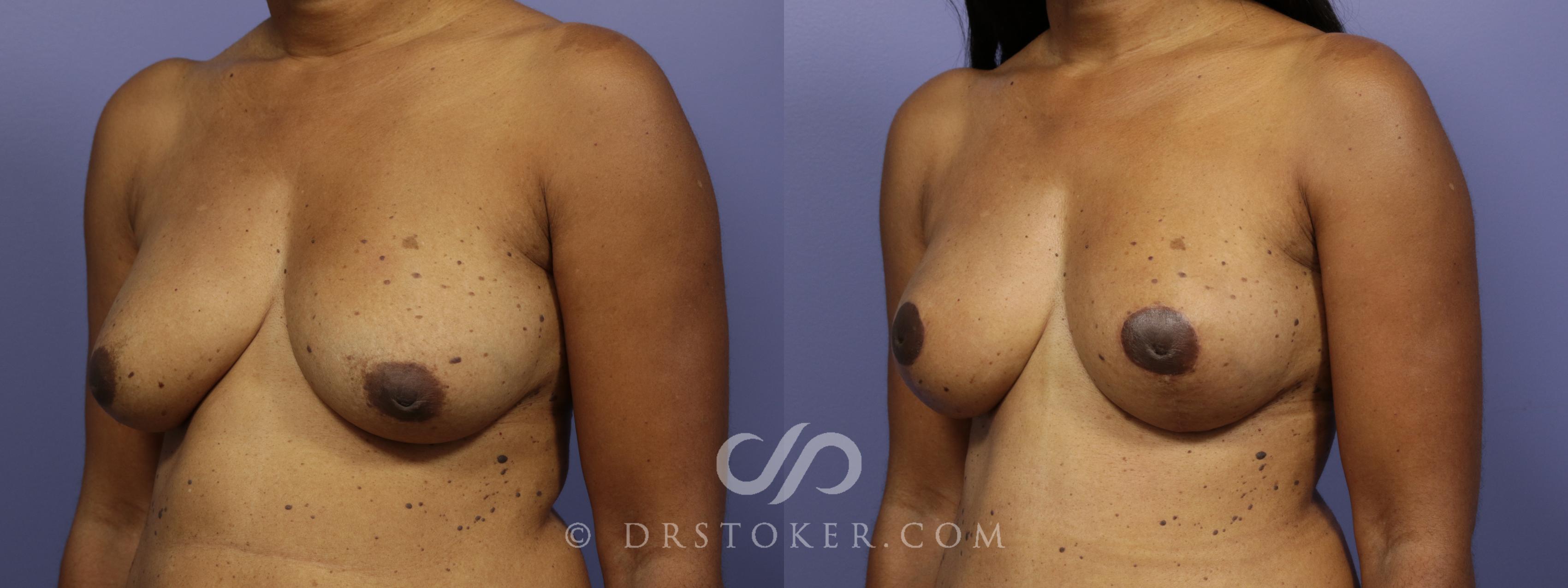 Before & After Breast Lift Case 942 View #4 View in Los Angeles, CA