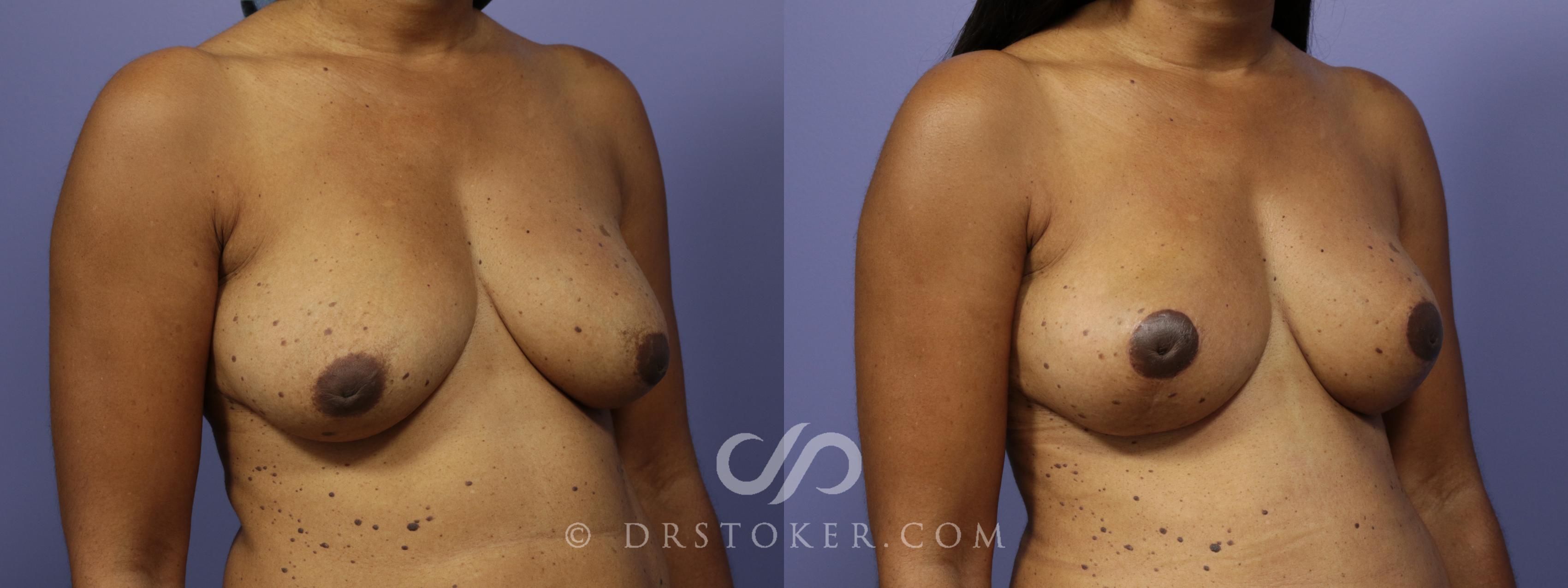 Before & After Breast Lift Case 942 View #5 View in Los Angeles, CA