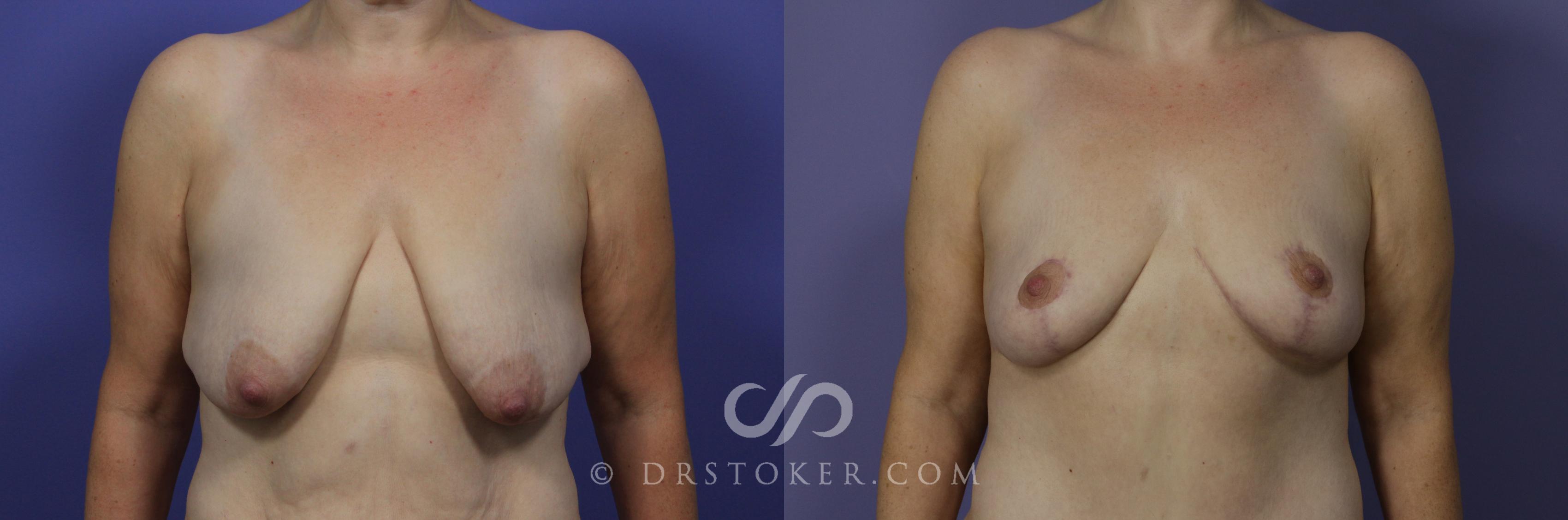 Before & After Breast Lift Case 943 View #1 View in Los Angeles, CA
