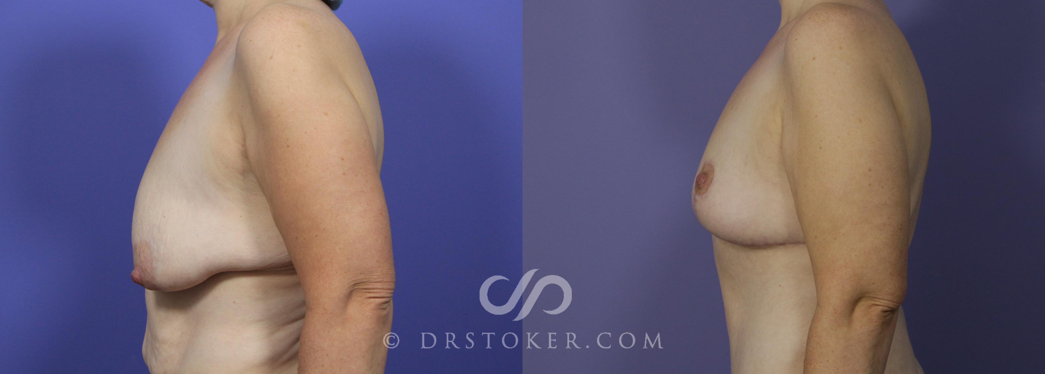 Before & After Breast Lift Case 943 View #3 View in Los Angeles, CA