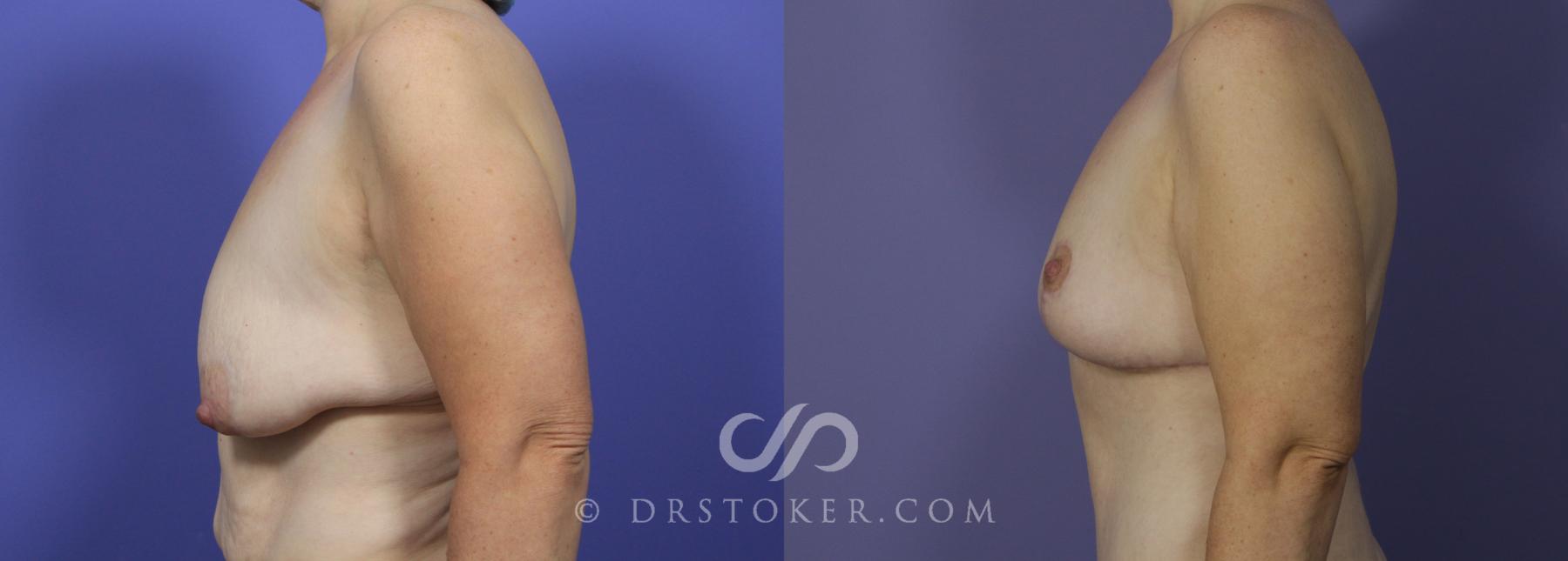 Before & After Breast Lift Case 943 View #3 View in Los Angeles, CA