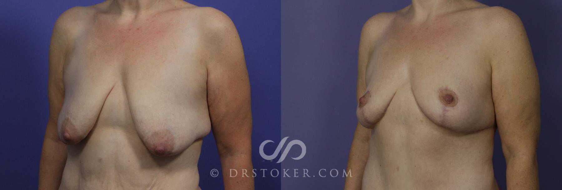 Before & After Breast Lift Case 943 View #4 View in Los Angeles, CA
