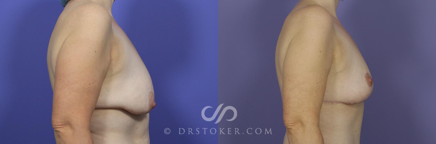 Before & After Breast Lift Case 943 View #5 View in Los Angeles, CA