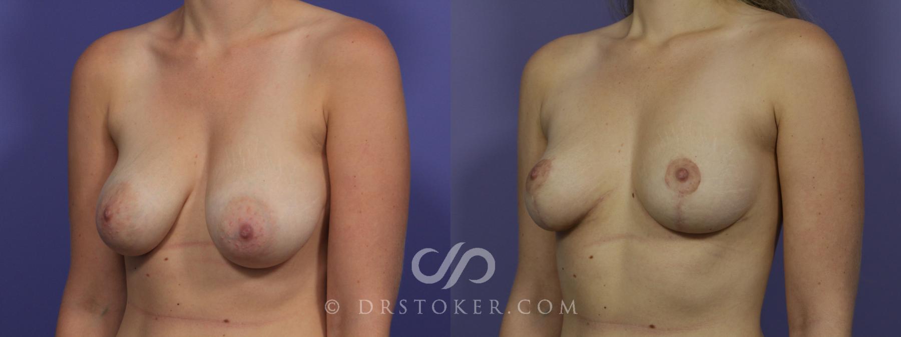 Before & After Breast Lift Case 944 View #3 View in Los Angeles, CA