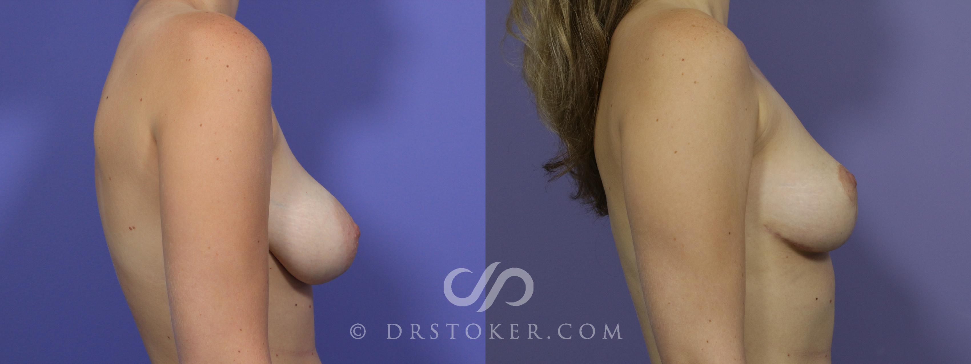 Before & After Breast Lift Case 944 View #5 View in Los Angeles, CA