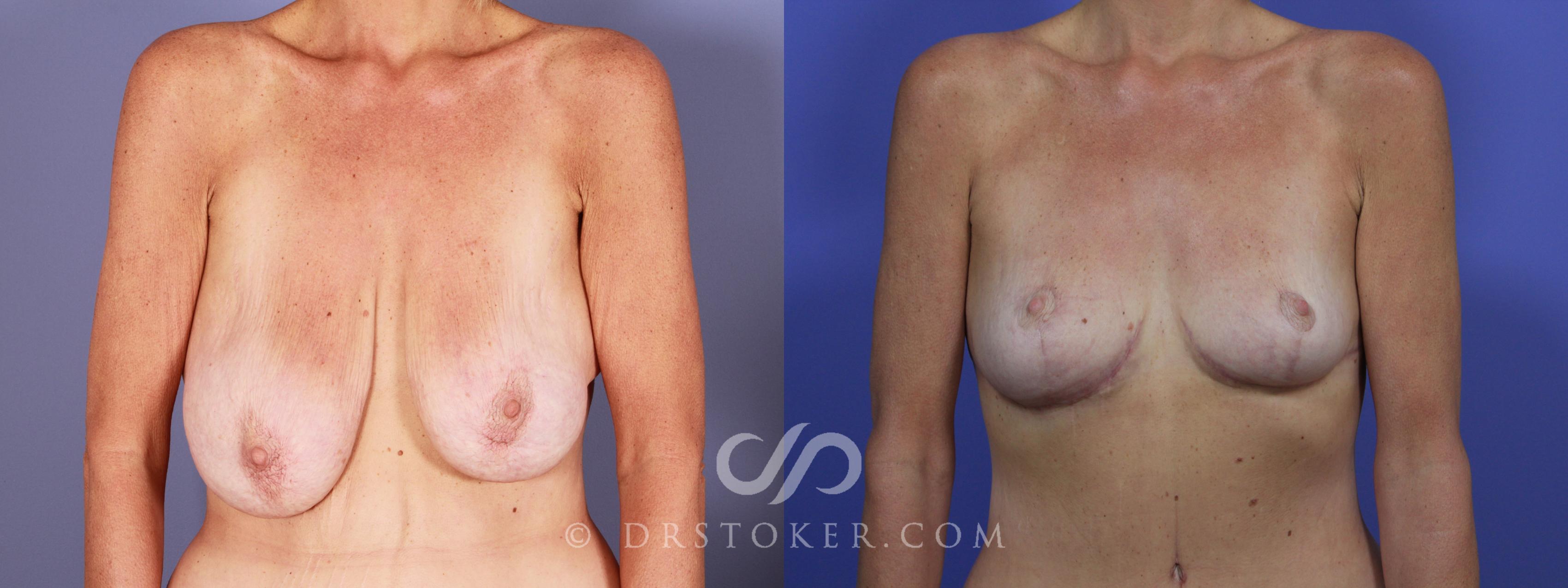 Before & After Breast Lift Case 945 View #1 View in Los Angeles, CA