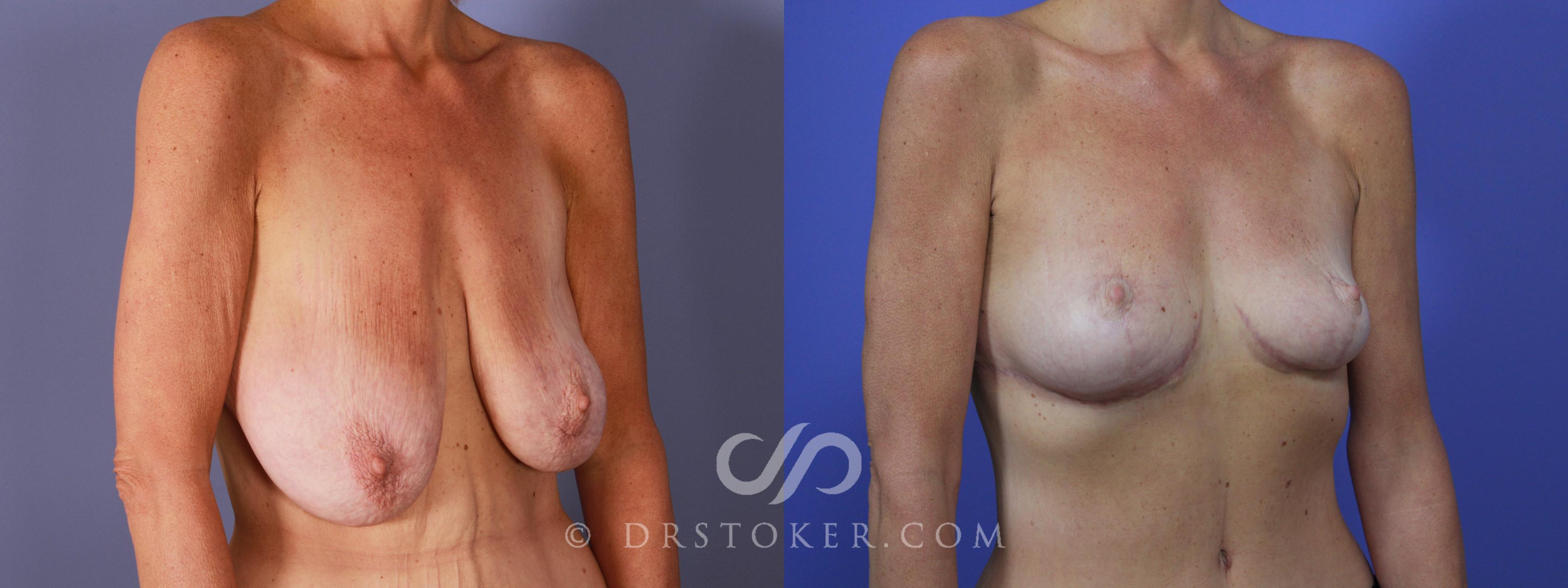 Before & After Breast Lift Case 945 View #2 View in Los Angeles, CA